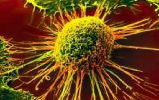 تحديد نسبة تقدم السرطان عبر معدات وشرائح تقنية النانو في إيران